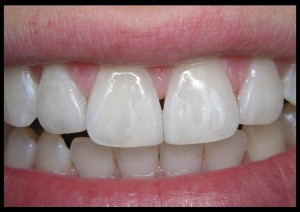 От чего зависит стоимость протезирования зубов